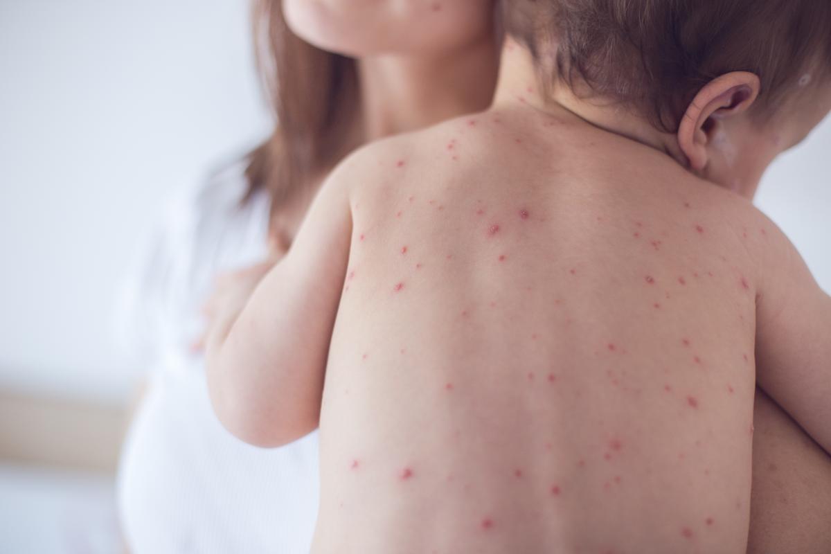 Chicken Pox Exposure Immune Deficiency Foundation